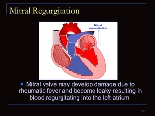 Mitral Regurgitation Mitral valve may develop damage due to rheumatic fever and become leaky resulting in blood regurgitating into the left atrium  