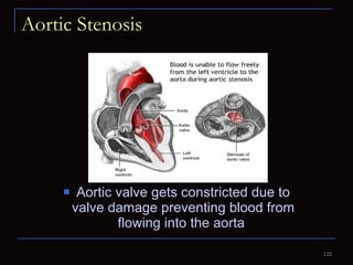 Aortic Stenosis Aortic valve gets constricted due to valve damage preventing blood from flowing into the aorta  