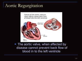 Aortic Regurgitation The aortic valve, when affected by disease cannot prevent back flow of blood in to the left ventricle  