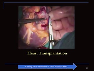 Heart Transplantation Coming up an Animation of Total Artificial Heart  