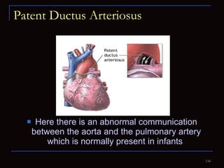 Patent Ductus Arteriosus Here there is an abnormal communication between the aorta and the pulmonary artery which is normally present in infants  