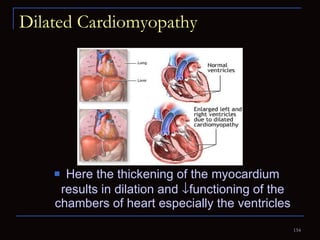 Dilated Cardiomyopathy Here the thickening of the myocardium results in dilation and   functioning of the chambers of heart especially the ventricles 