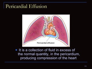 Pericardial Effusion It is a collection of fluid in excess of  the normal quantity, in the pericardium, producing compression of the heart  