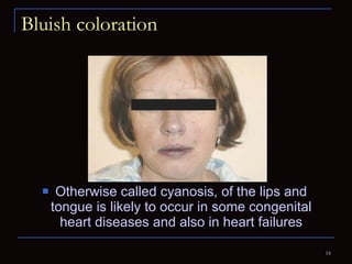 Bluish coloration Otherwise called cyanosis, of the lips and tongue is likely to occur in some congenital heart diseases and also in heart failures 