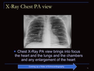 X-Ray Chest PA view Chest X-Ray PA view brings into focus the heart and the lungs and the chambers and any enlargement of the heart  Coming up a Video of Echocardiography 
