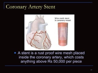 Coronary Artery Stent A stent is a rust proof wire mesh placed inside the coronary artery, which costs anything above Rs 50,000 per piece 