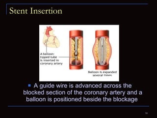 Stent Insertion A guide wire is advanced across the blocked section of the coronary artery and a balloon is positioned beside the blockage  