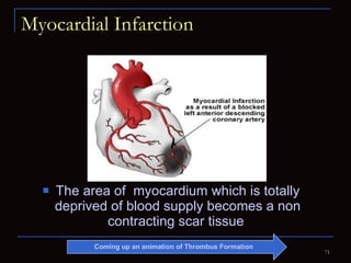 Myocardial Infarction The area of  myocardium which is totally deprived of blood supply becomes a non contracting scar tissue  Coming up an animation of Thrombus Formation 