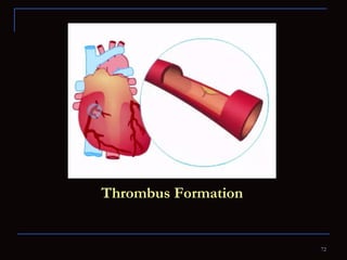 Thrombus Formation 