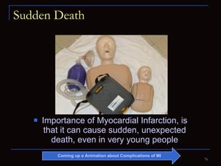Sudden Death Importance of Myocardial Infarction, is that it can cause sudden, unexpected death, even in very young people Coming up a Animation about Complications of MI 