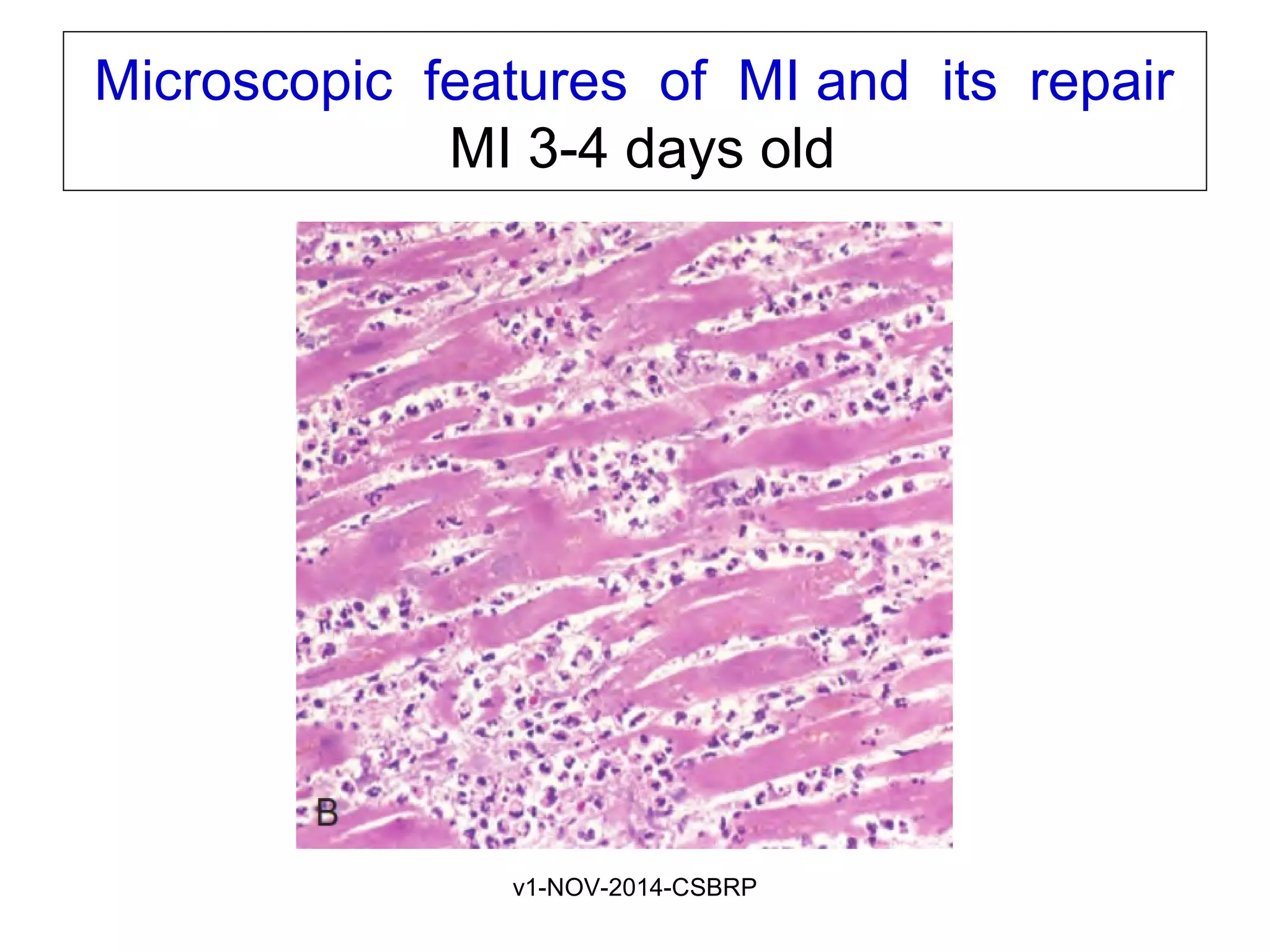v1-NOV-2014-CSBRP
Microscopic features of MI and its repair
MI 3-4 days old
 