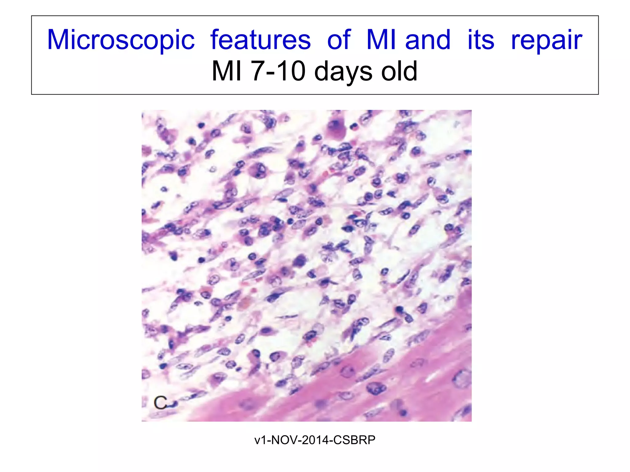 v1-NOV-2014-CSBRP
Microscopic features of MI and its repair
MI 7-10 days old
 