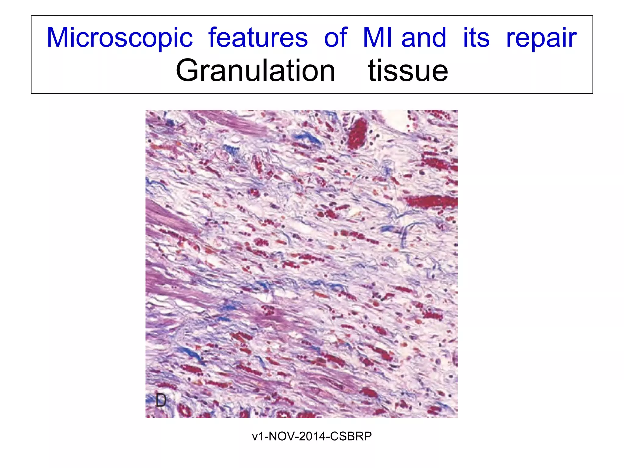 v1-NOV-2014-CSBRP
Microscopic features of MI and its repair
Granulation tissue 
 