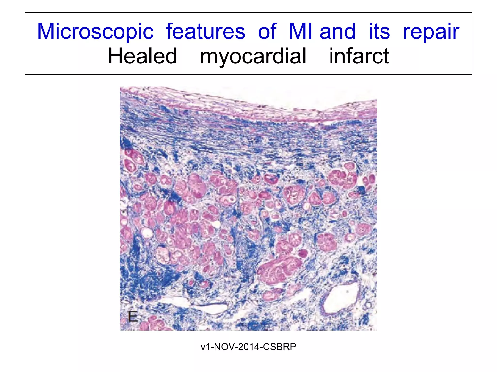 v1-NOV-2014-CSBRP
Microscopic features of MI and its repair
Healed myocardial infarct   
 