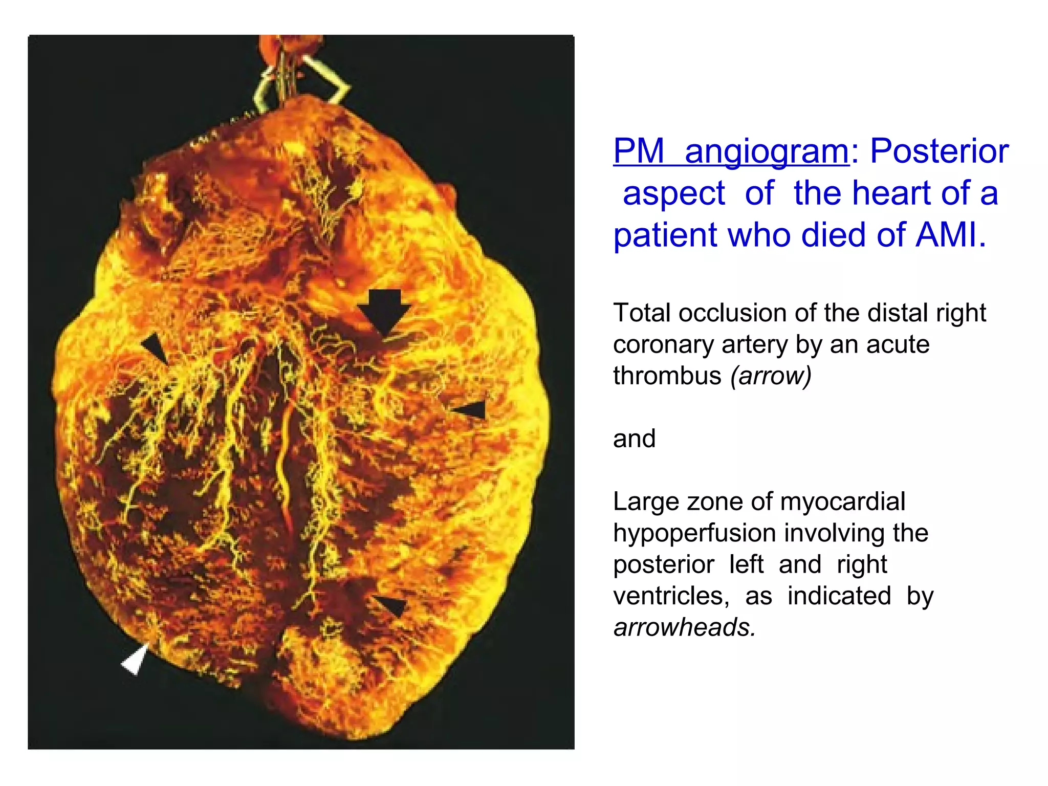 PM angiogram: Posterior
aspect of the heart of a
patient who died of AMI.
Total occlusion of the distal right
coronary artery by an acute
thrombus (arrow)
and
Large zone of myocardial
hypoperfusion involving the
posterior left and right
ventricles, as indicated by
arrowheads.
 
