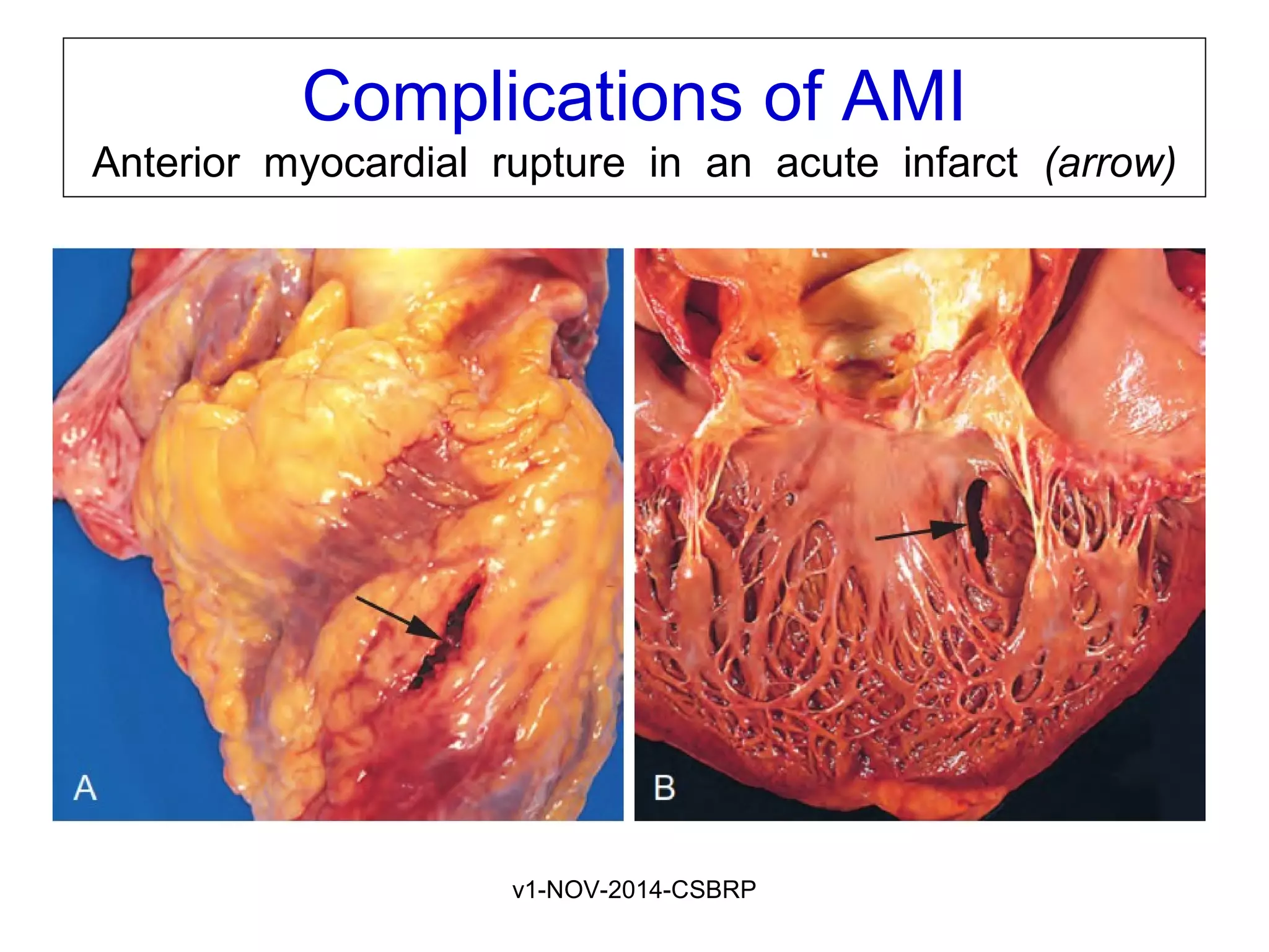 v1-NOV-2014-CSBRP
Complications of AMI
Anterior myocardial rupture in an acute infarct (arrow)
 