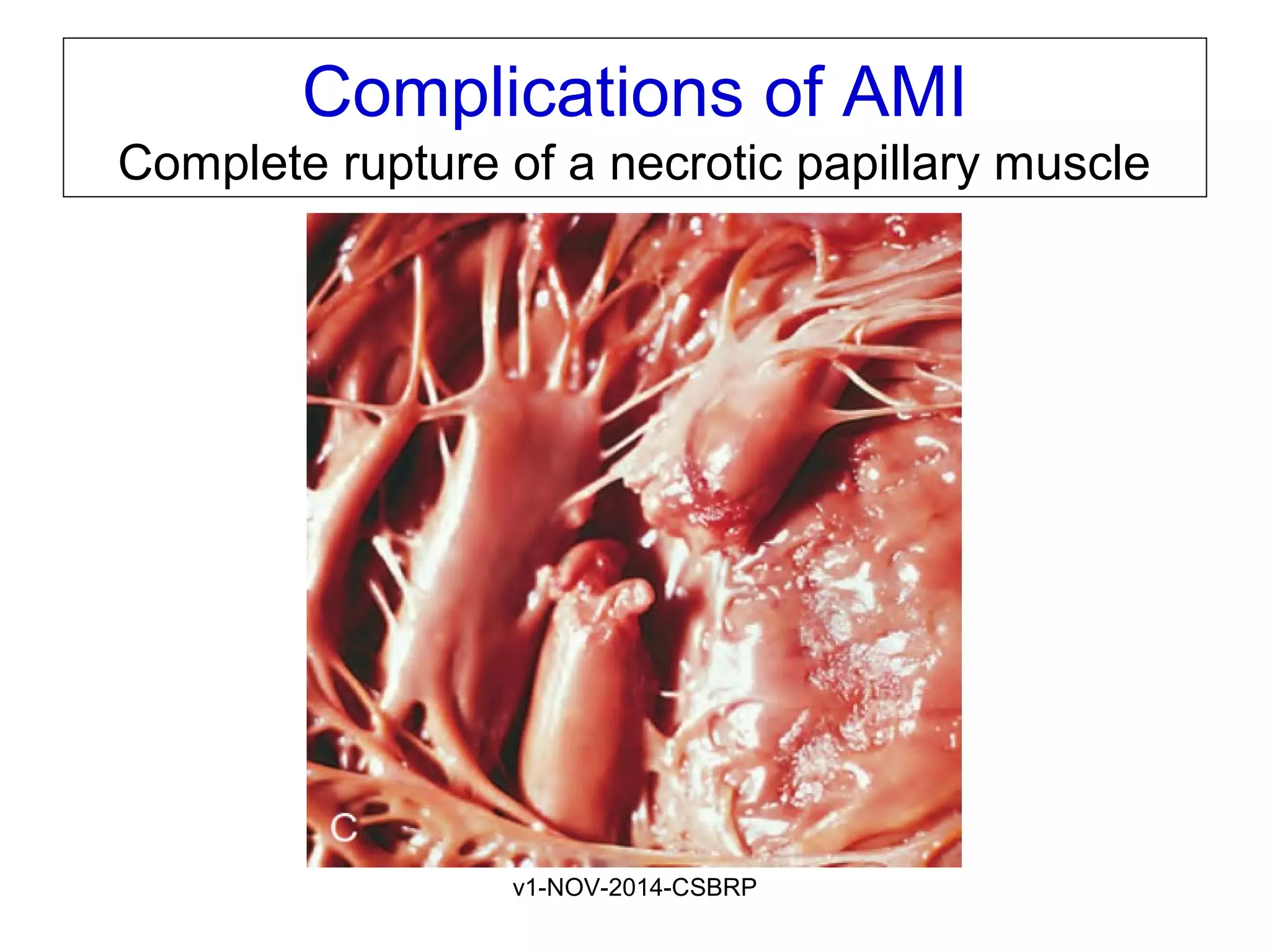 v1-NOV-2014-CSBRP
Complications of AMI
Complete rupture of a necrotic papillary muscle
 
