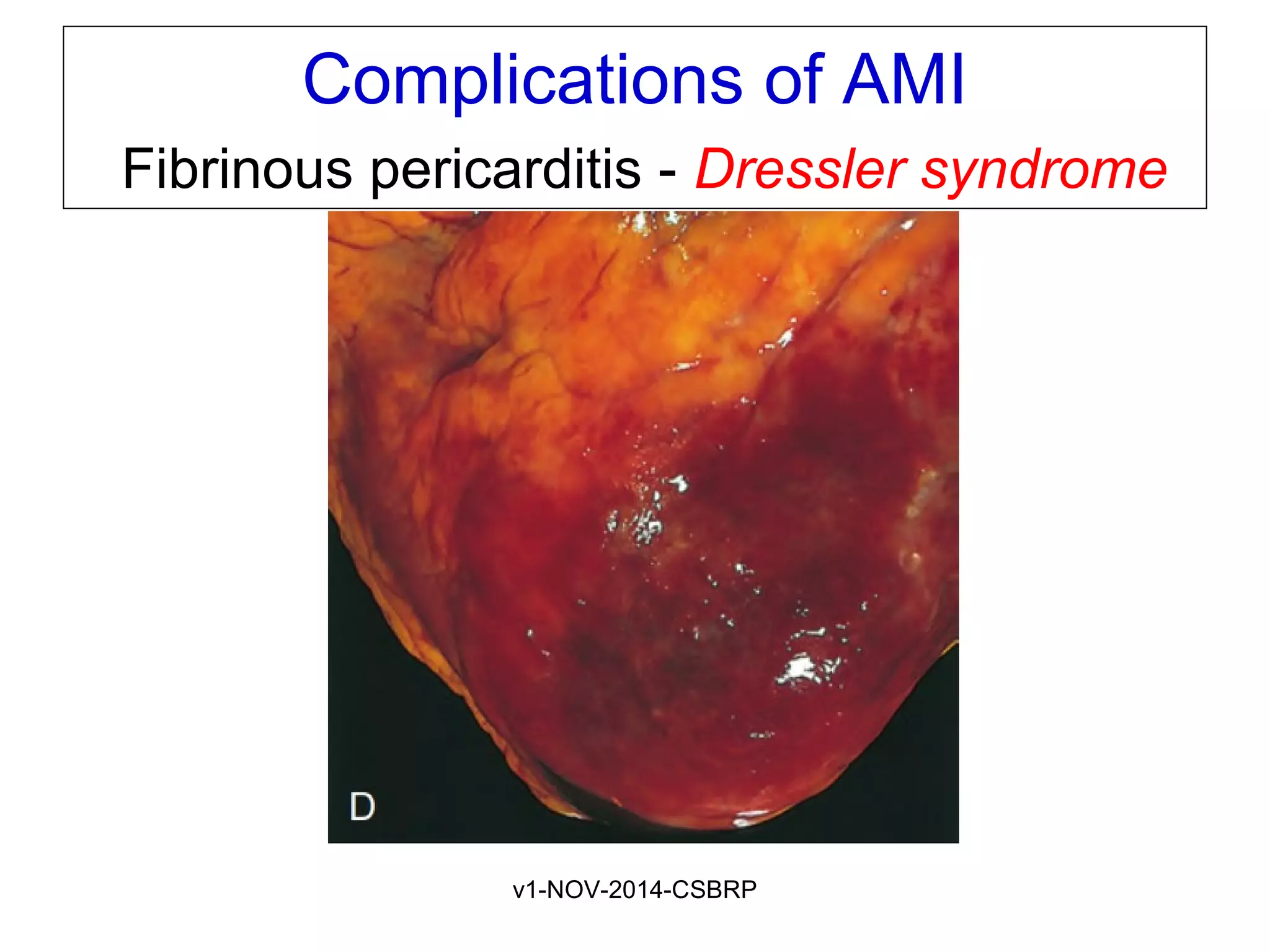 v1-NOV-2014-CSBRP
Complications of AMI
Fibrinous pericarditis - Dressler syndrome
 