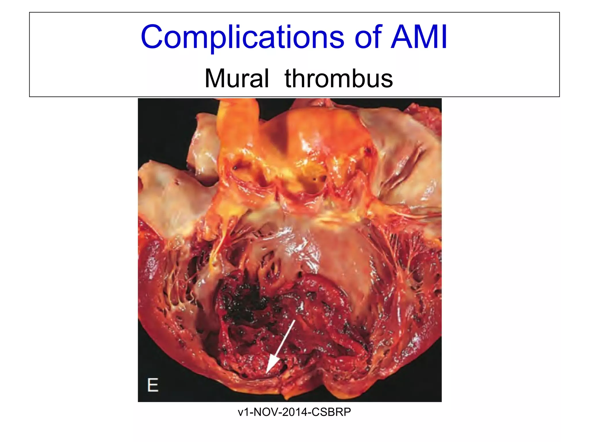 v1-NOV-2014-CSBRP
Complications of AMI
Mural thrombus
 