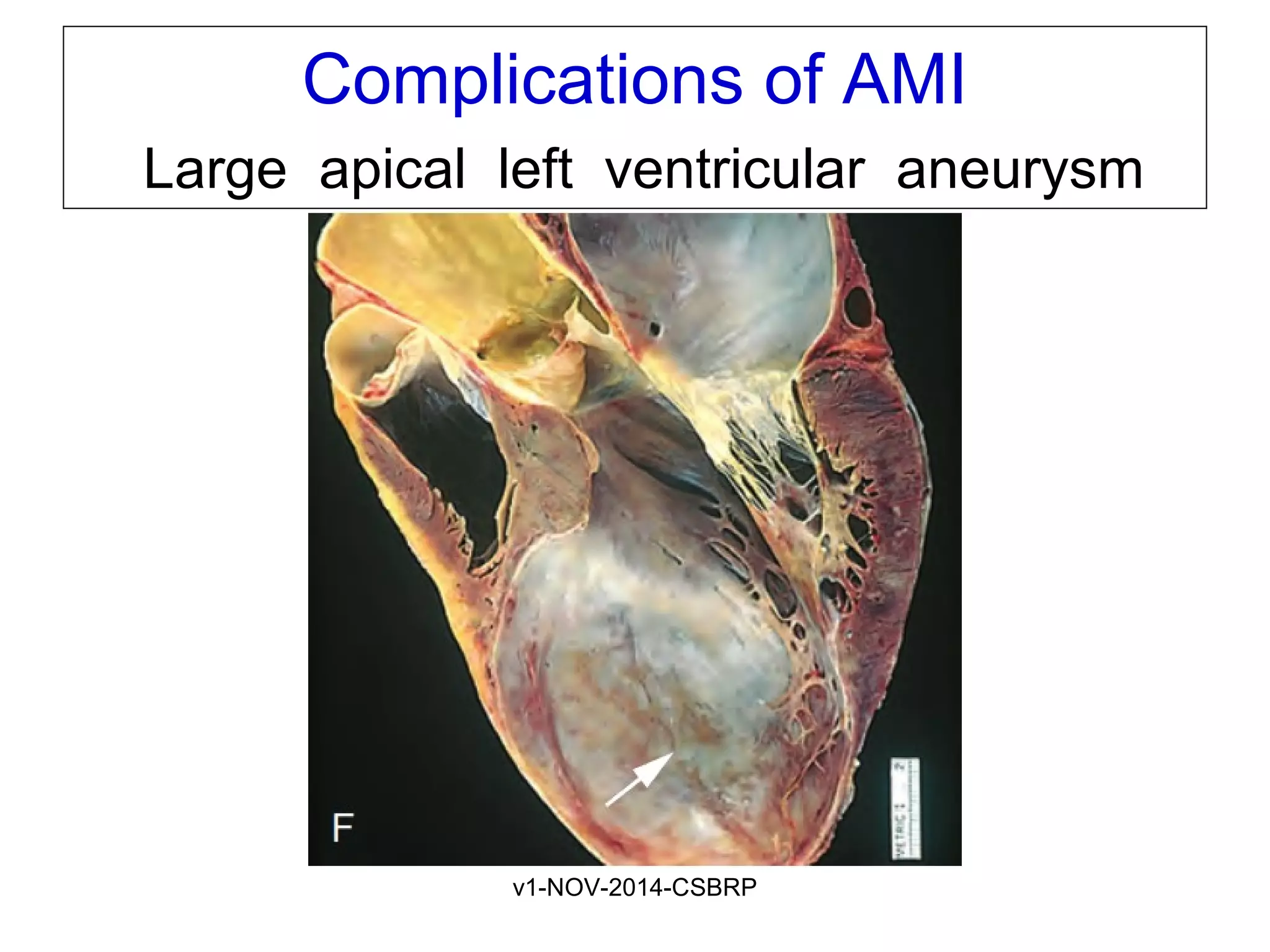 v1-NOV-2014-CSBRP
Complications of AMI
Large apical left ventricular aneurysm
 