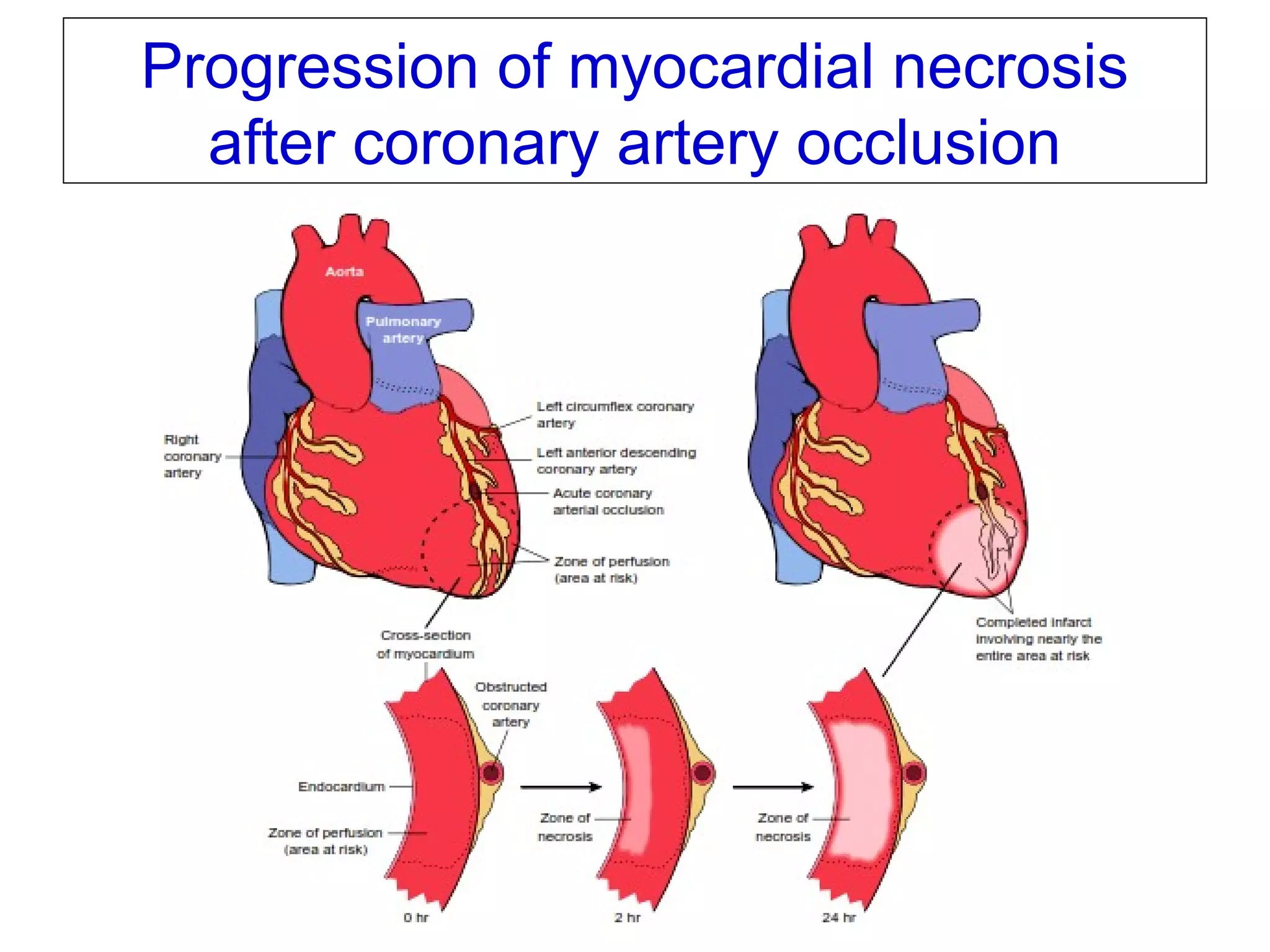 v1-NOV-2014-CSBRP
Progression of myocardial necrosis
after coronary artery occlusion
 