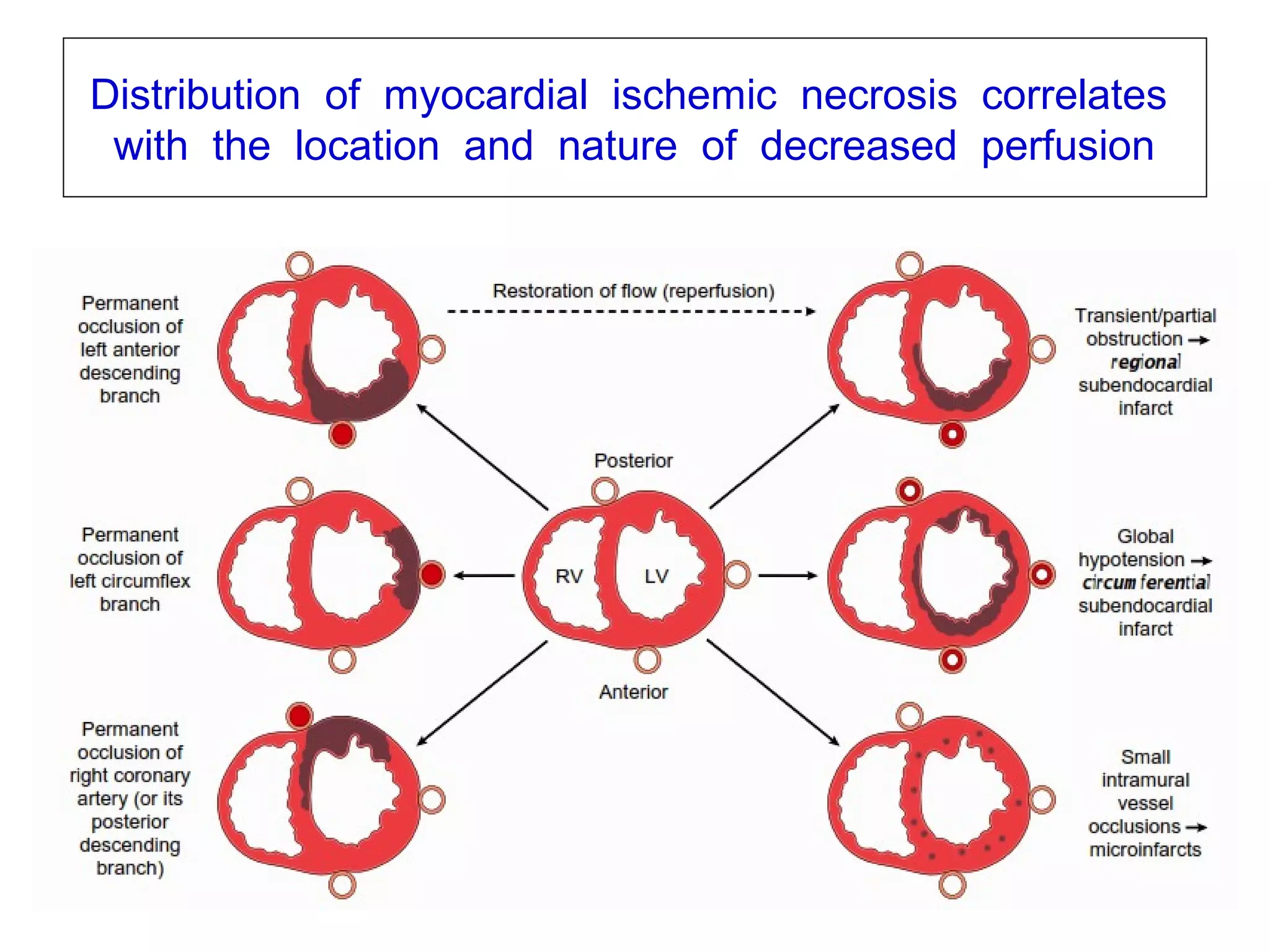 v1-NOV-2014-CSBRP
Distribution of myocardial ischemic necrosis correlates
with the location and nature of decreased perfusion
 