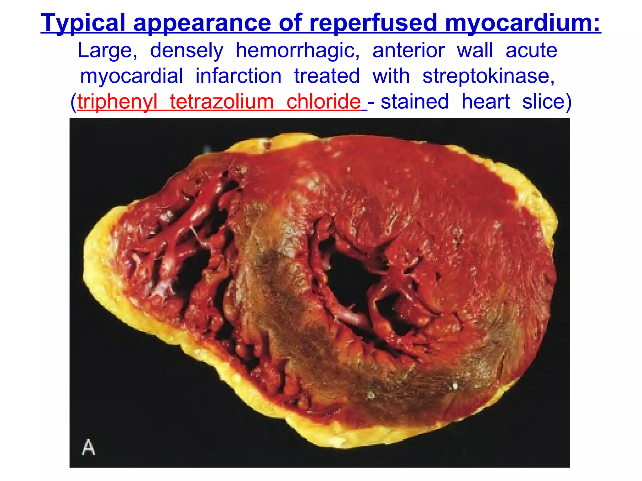 v1-NOV-2014-CSBRP
Typical appearance of reperfused myocardium:
Large, densely hemorrhagic, anterior wall acute
myocardial infarction treated with streptokinase,
(triphenyl tetrazolium chloride - stained heart slice)
 