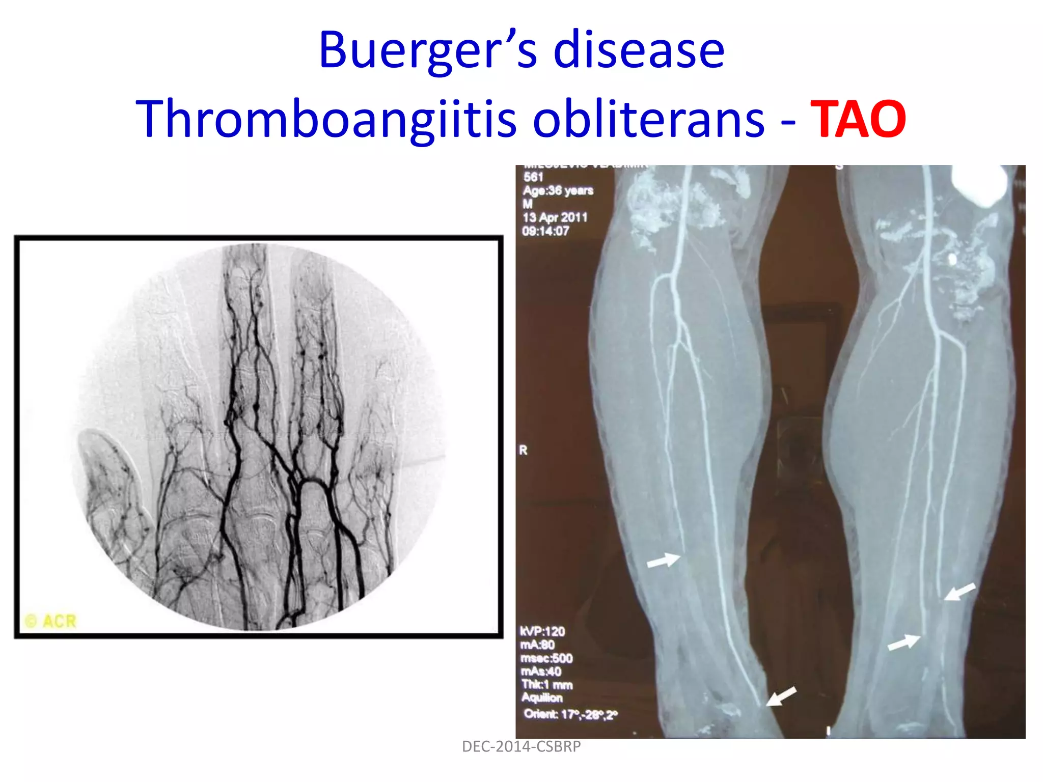 Buerger’s disease
Thromboangiitis obliterans - TAO
DEC-2014-CSBRP
 
