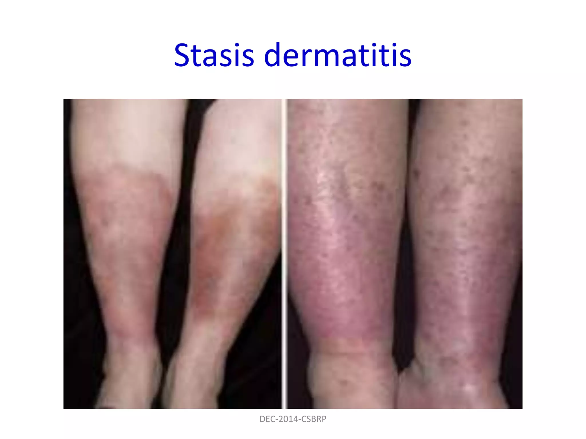 Stasis dermatitis
DEC-2014-CSBRP
 