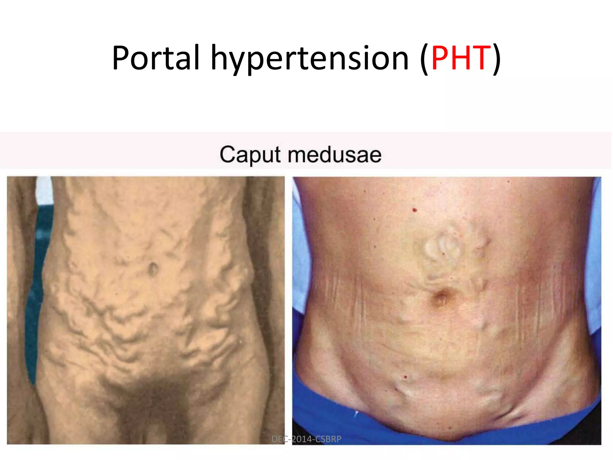 Portal hypertension (PHT)
DEC-2014-CSBRP
 