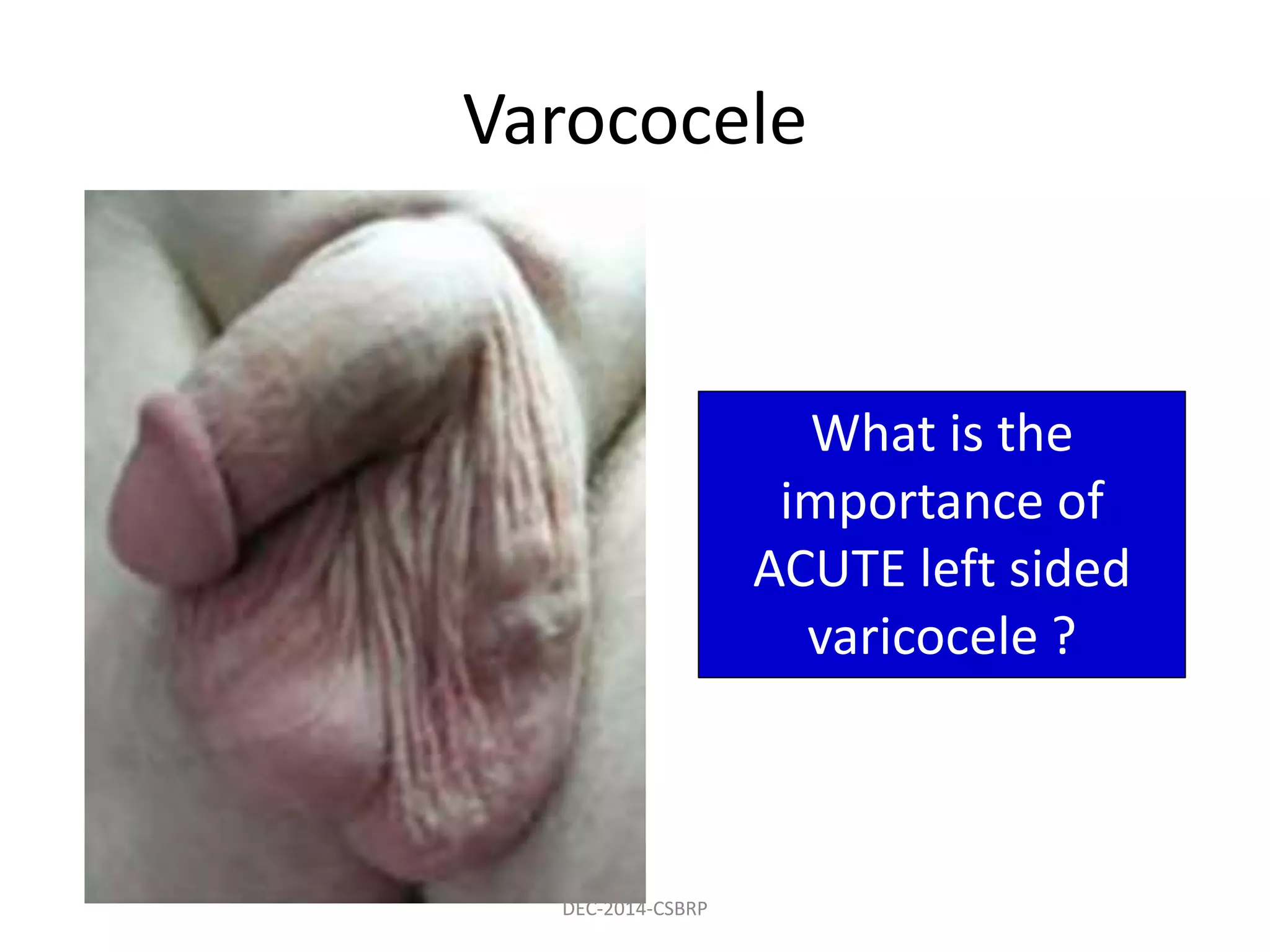 Varococele
What is the
importance of
ACUTE left sided
varicocele ?
DEC-2014-CSBRP
 