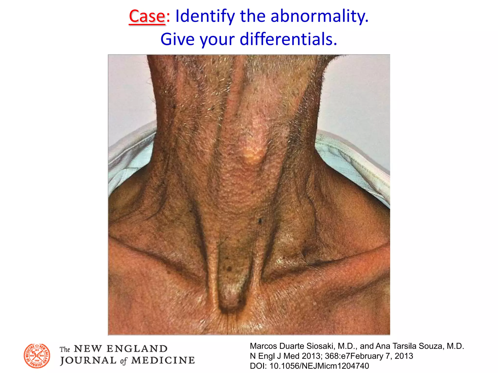 Case: Identify the abnormality.
Give your differentials.
Marcos Duarte Siosaki, M.D., and Ana Tarsila Souza, M.D.
N Engl J Med 2013; 368:e7February 7, 2013
DOI: 10.1056/NEJMicm1204740
 