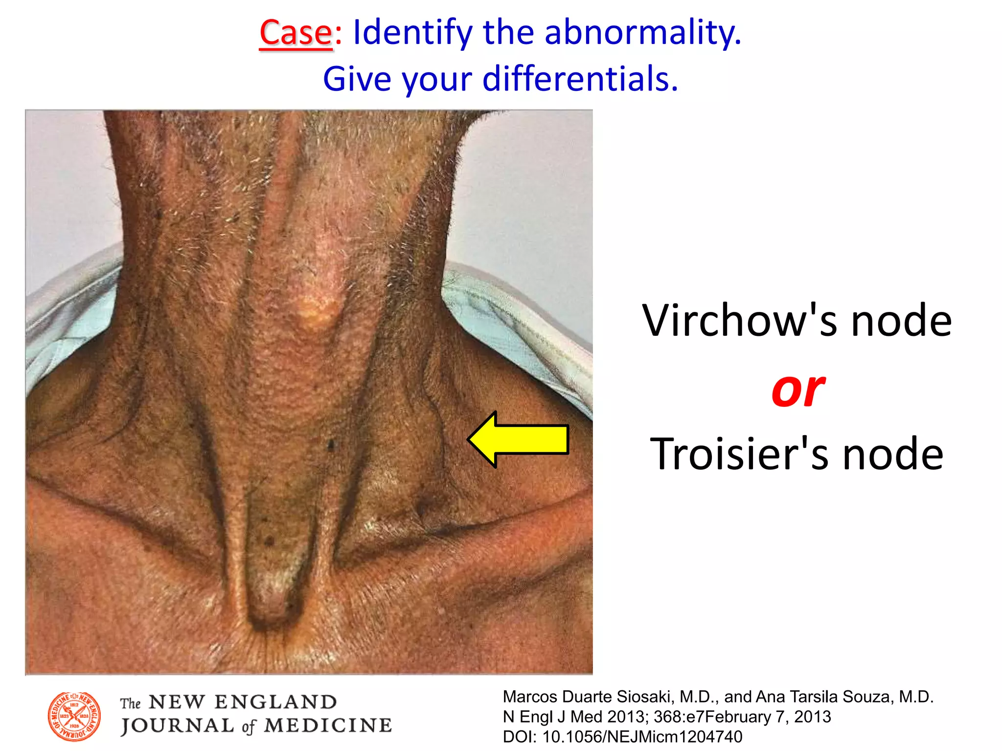 Case: Identify the abnormality.
Give your differentials.
Marcos Duarte Siosaki, M.D., and Ana Tarsila Souza, M.D.
N Engl J Med 2013; 368:e7February 7, 2013
DOI: 10.1056/NEJMicm1204740
Virchow's node
or
Troisier's node
 