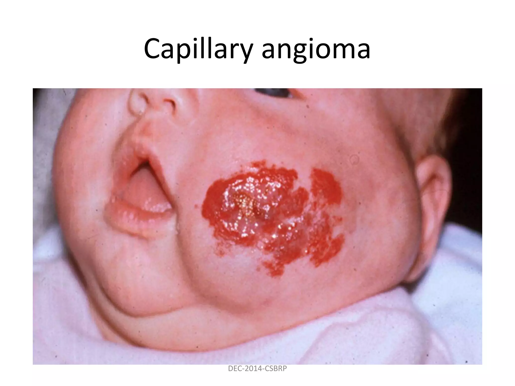 Capillary angioma
DEC-2014-CSBRP
 