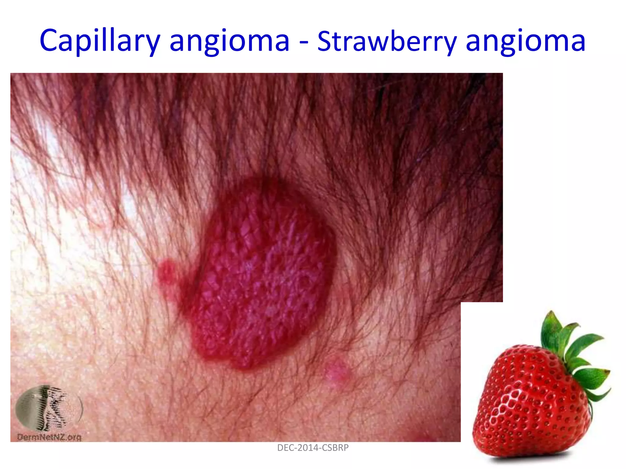 Capillary angioma - Strawberry angioma
DEC-2014-CSBRP
 