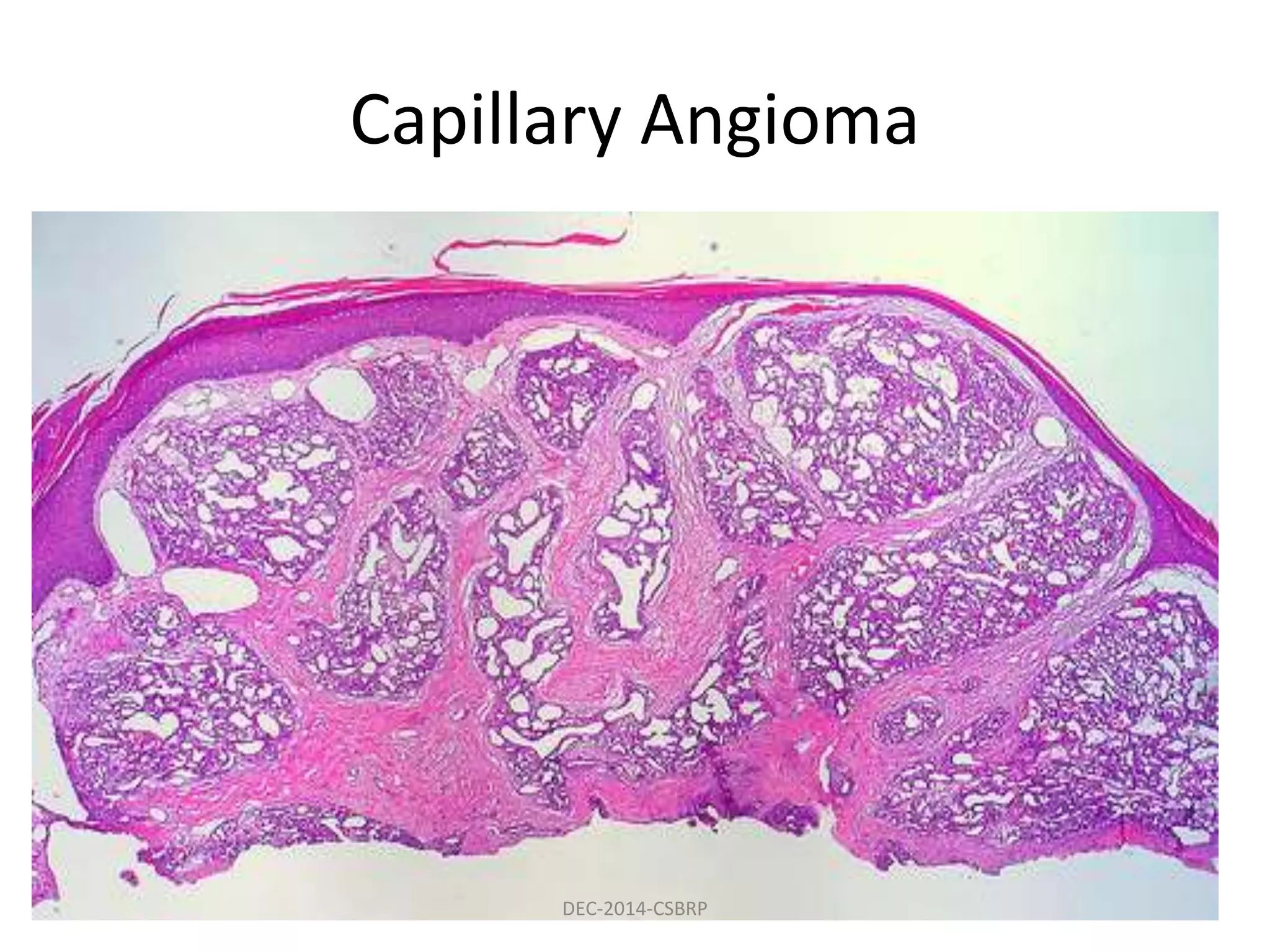 Capillary Angioma
DEC-2014-CSBRP
 