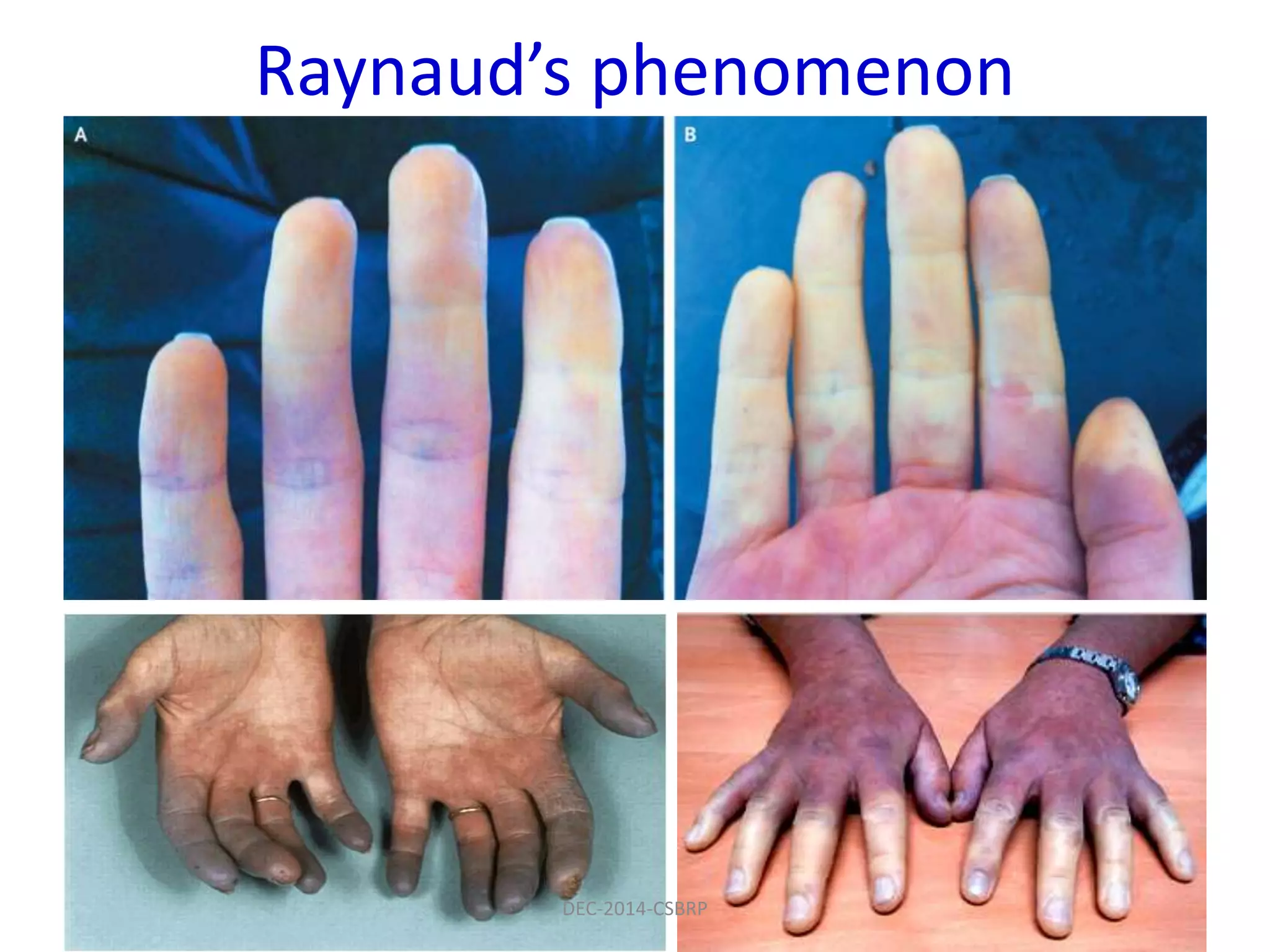 Raynaud’s phenomenon
DEC-2014-CSBRP
 