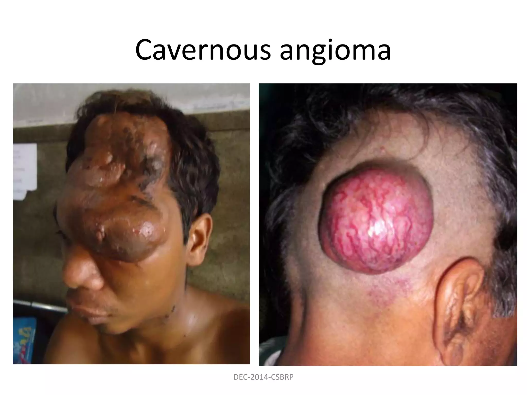 Cavernous angioma
DEC-2014-CSBRP
 