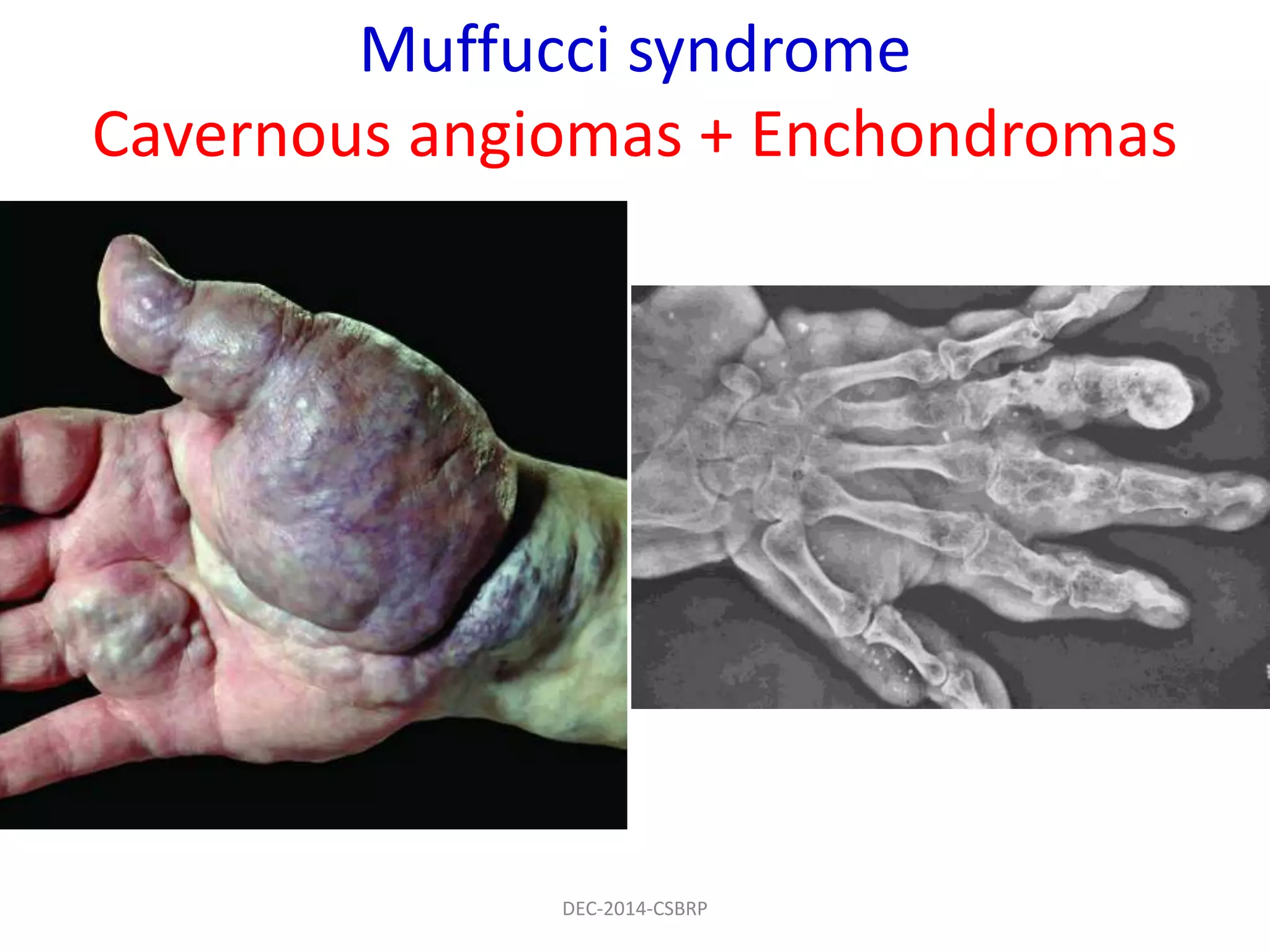 Muffucci syndrome
Cavernous angiomas + Enchondromas
DEC-2014-CSBRP
 