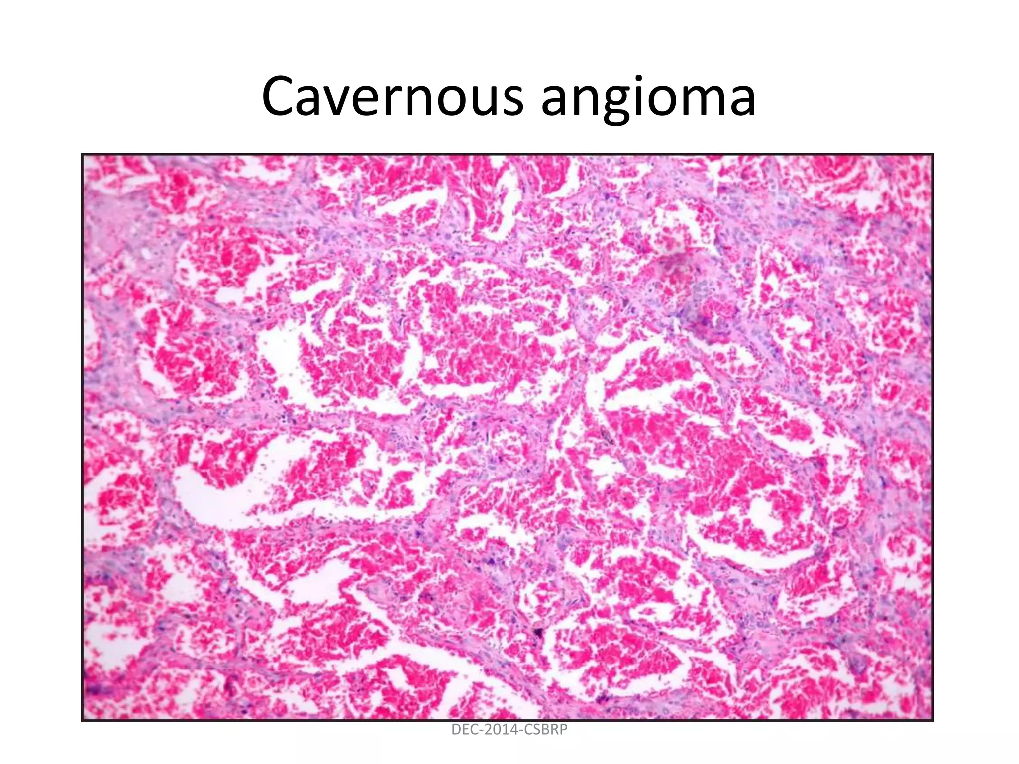 Cavernous angioma
DEC-2014-CSBRP
 