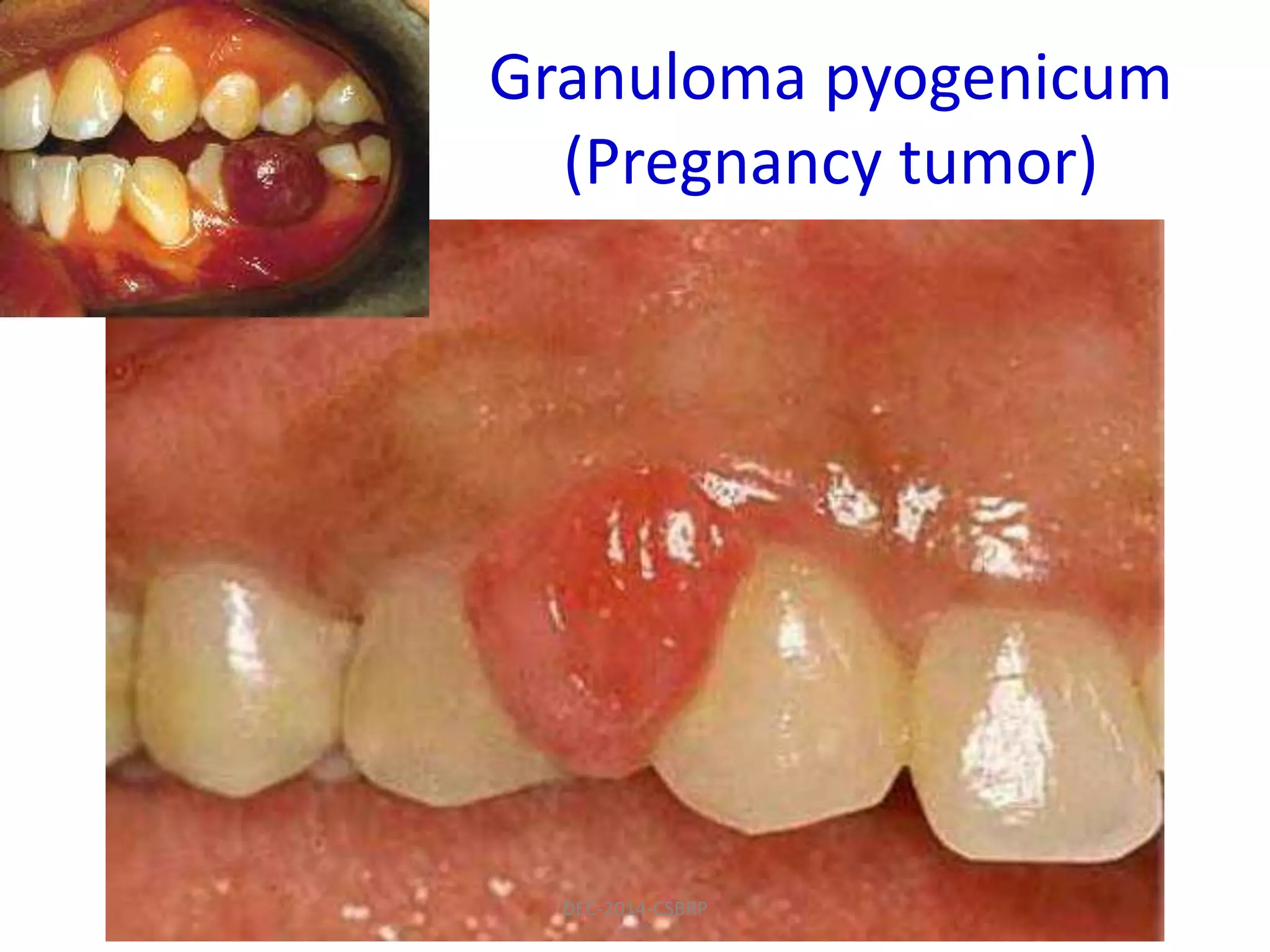 Granuloma pyogenicum
(Pregnancy tumor)
DEC-2014-CSBRP
 