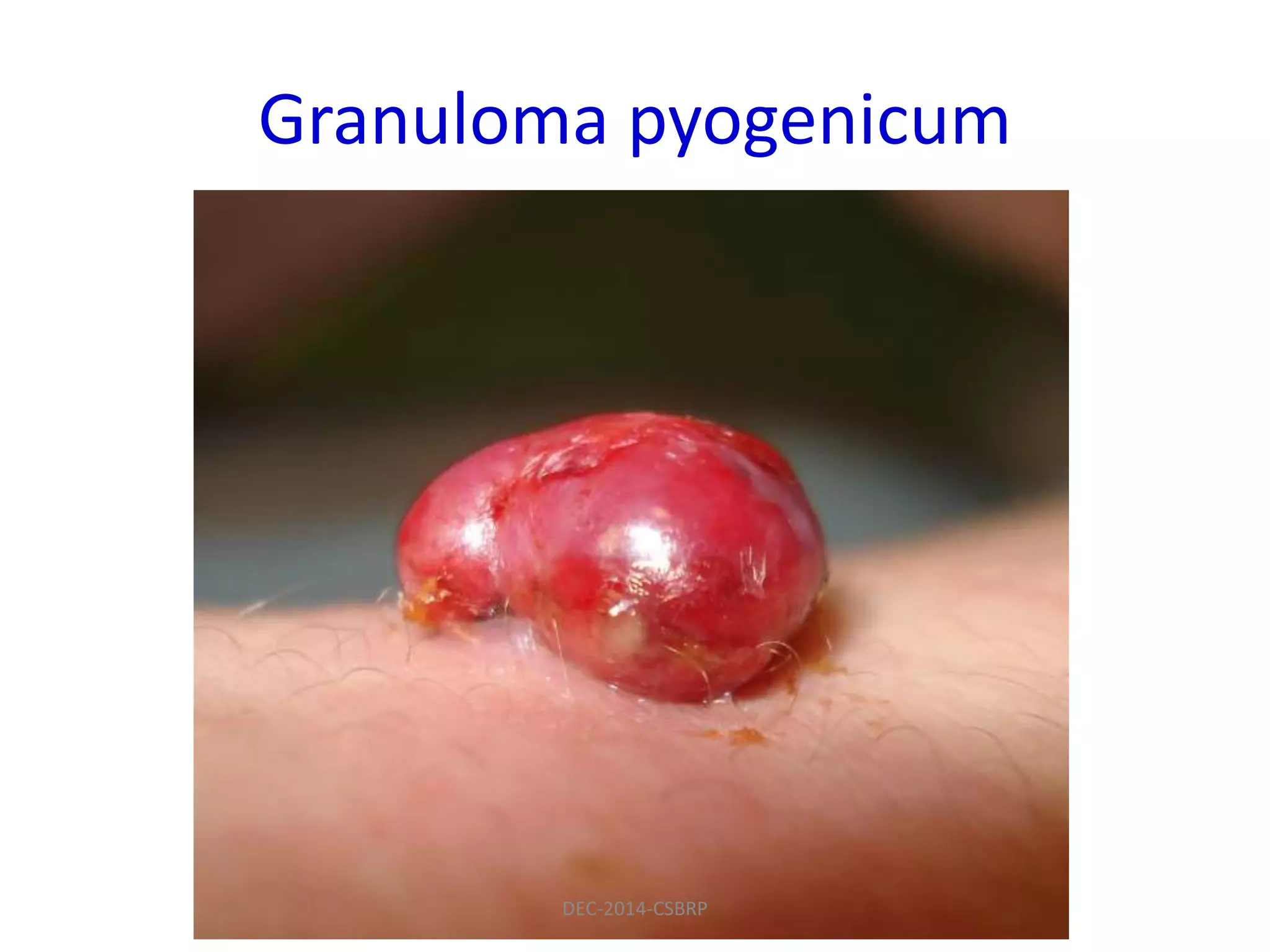 Granuloma pyogenicum
DEC-2014-CSBRP
 