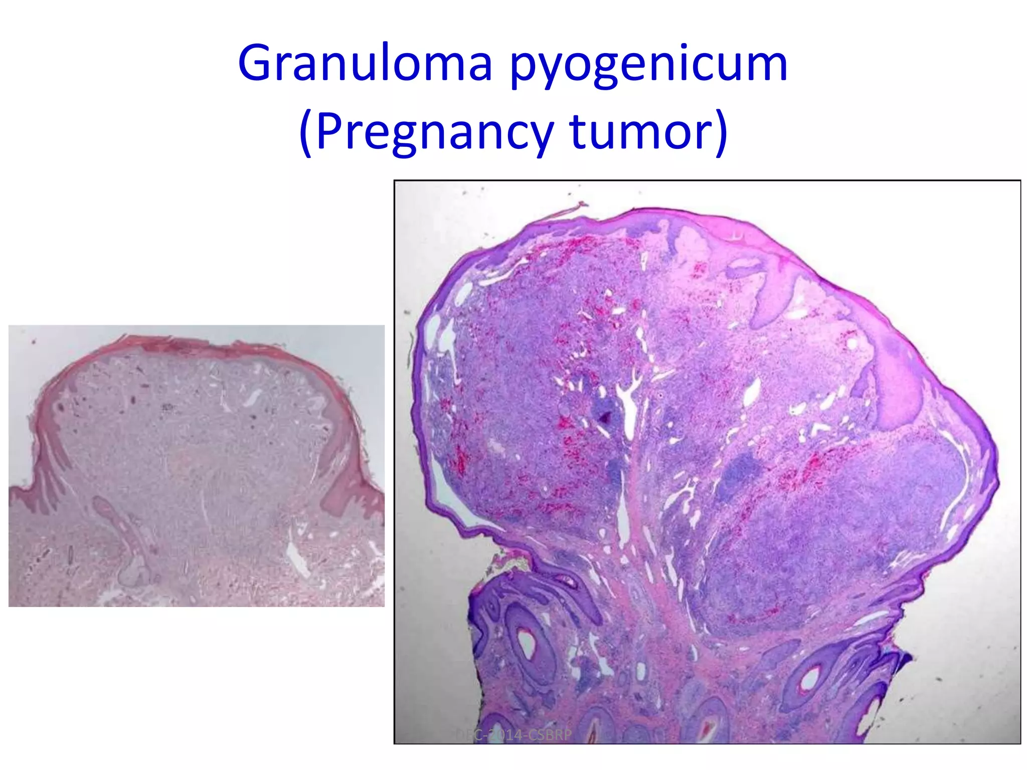 Granuloma pyogenicum
(Pregnancy tumor)
DEC-2014-CSBRP
 
