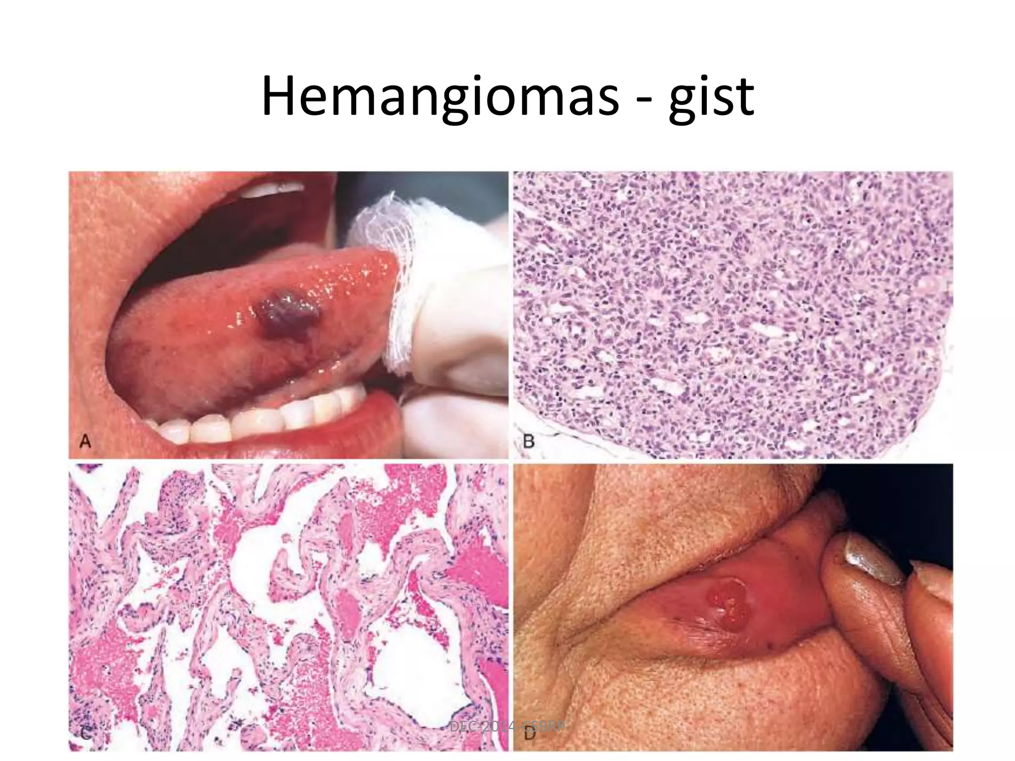 Hemangiomas - gist
DEC-2014-CSBRP
 