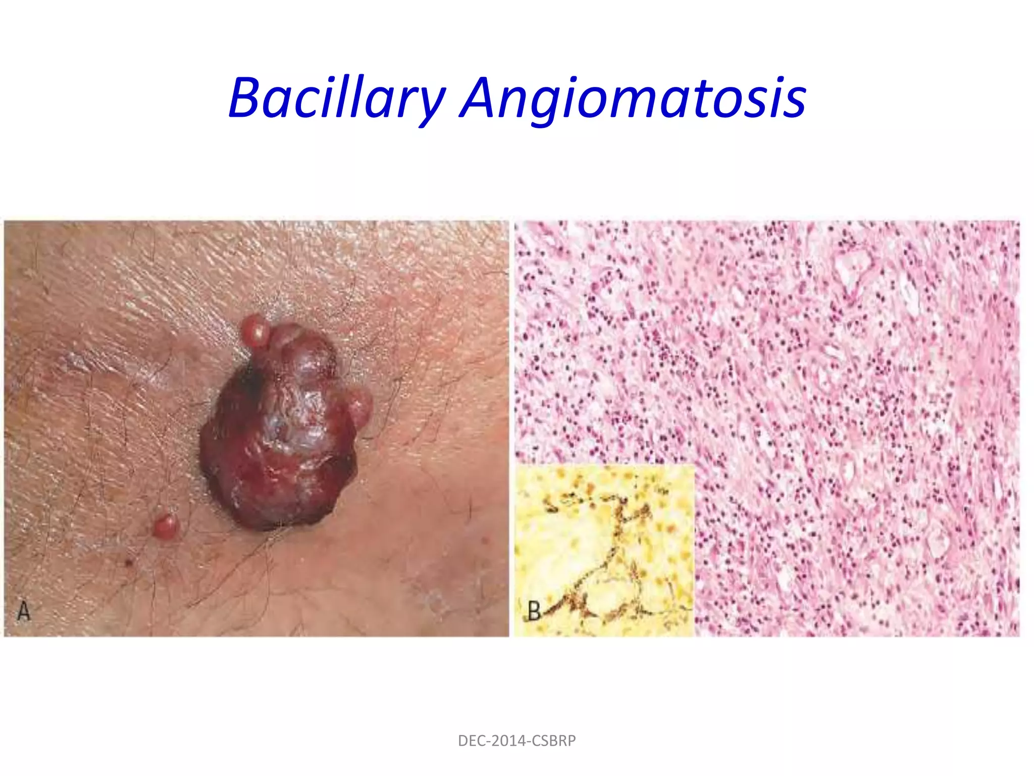 Bacillary Angiomatosis
DEC-2014-CSBRP
 