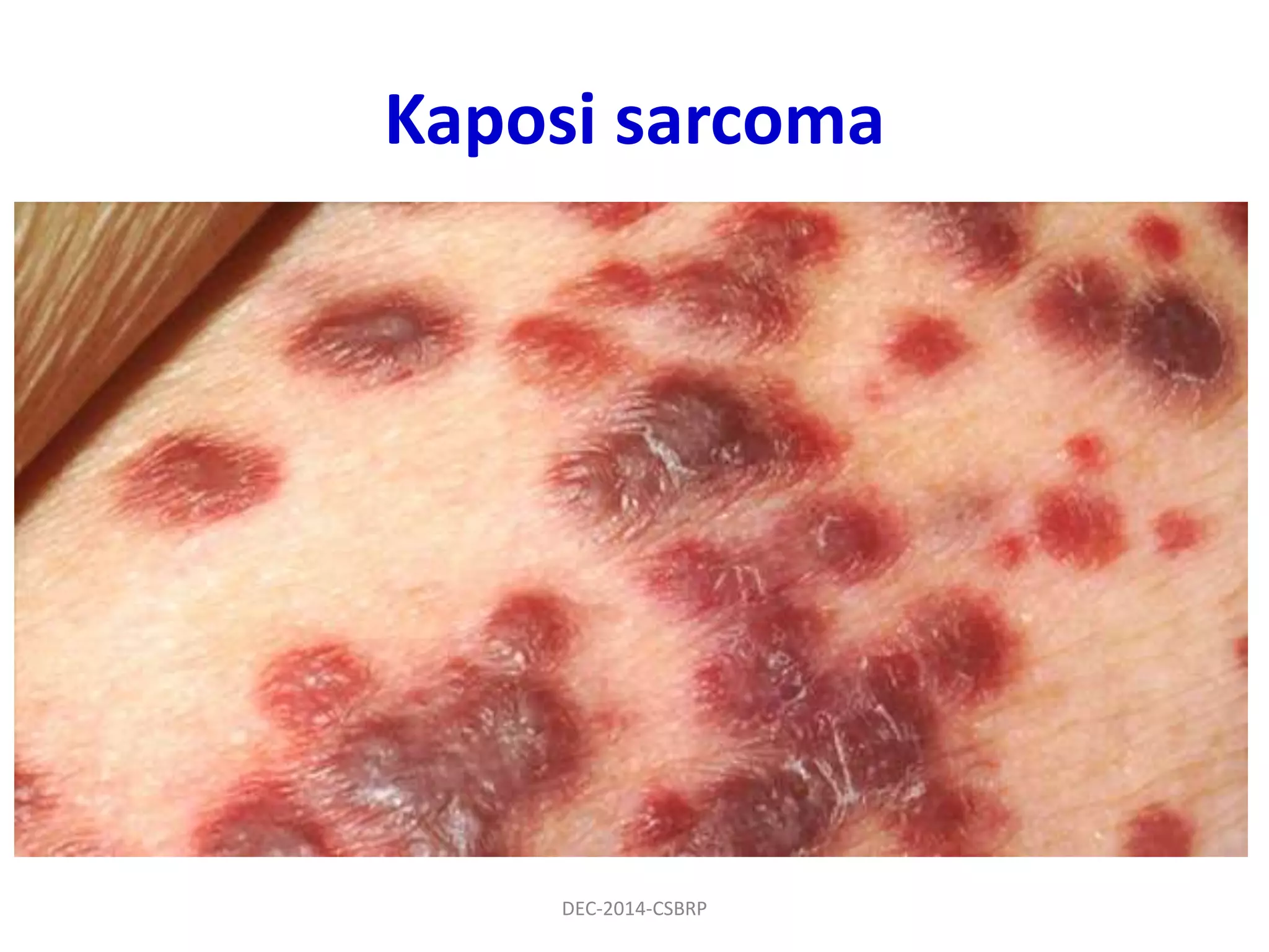 Kaposi sarcoma
DEC-2014-CSBRP
 