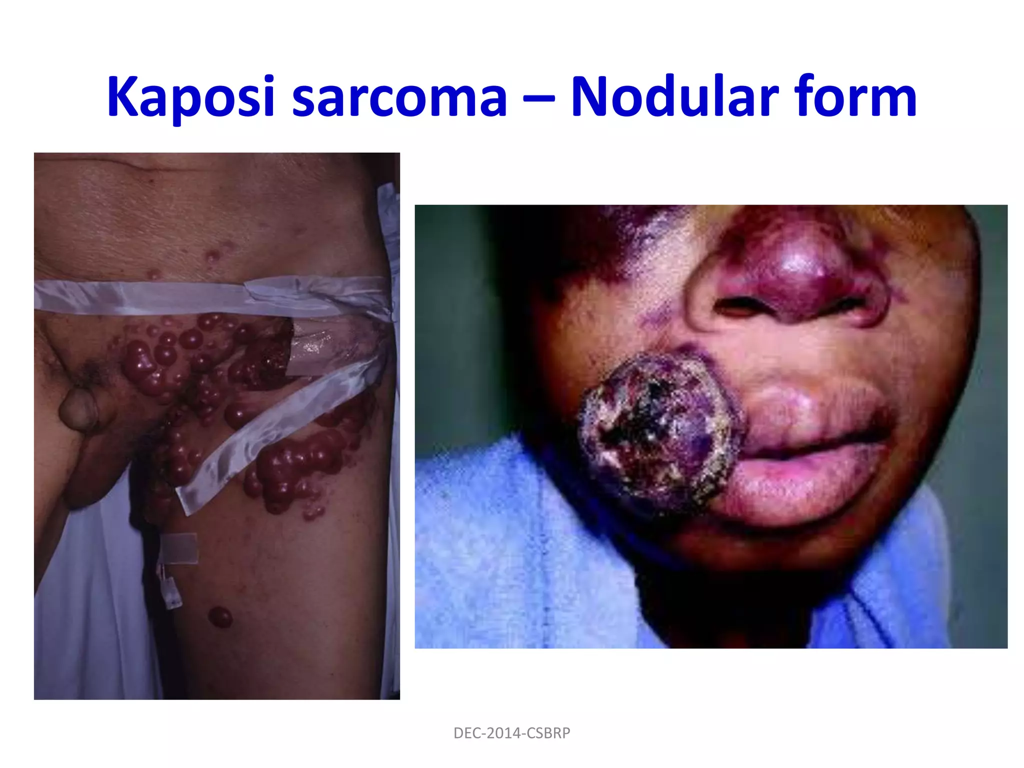 Kaposi sarcoma – Nodular form
DEC-2014-CSBRP
 