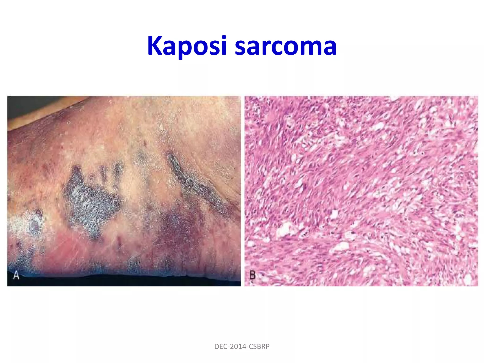 Kaposi sarcoma
DEC-2014-CSBRP
 