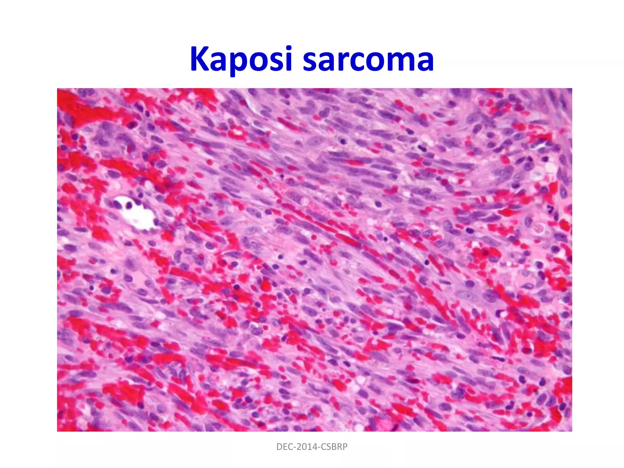 Kaposi sarcoma
DEC-2014-CSBRP
 