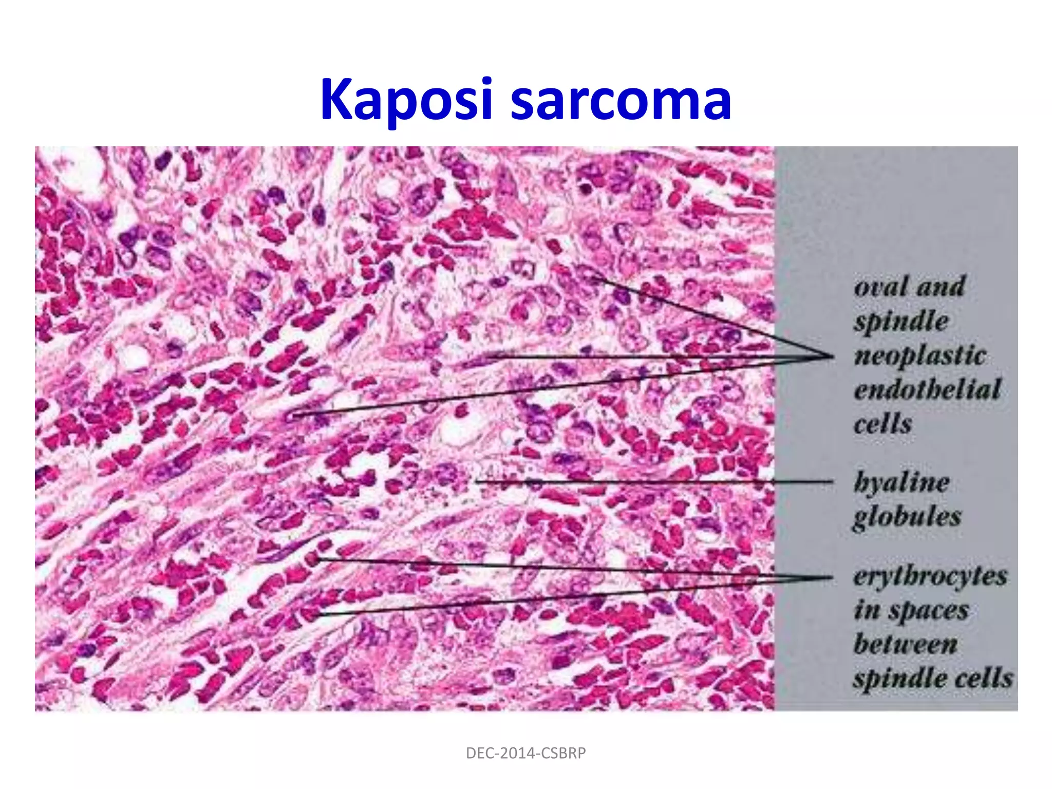 Kaposi sarcoma
DEC-2014-CSBRP
 